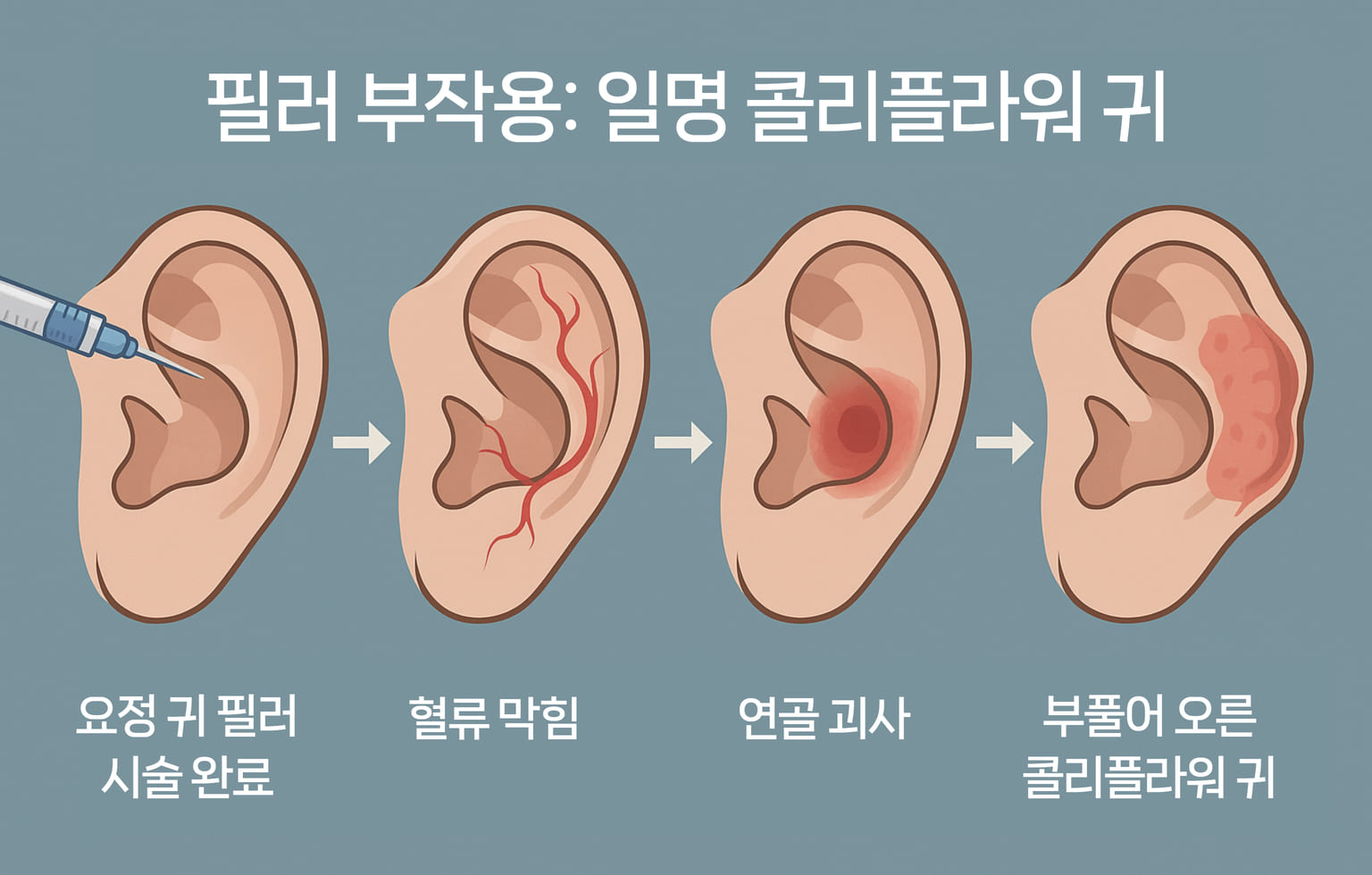 성형외과의도 혀를 내두를 정도로 위험한 시술인 귀 필러. 귀 필러의 부작용도 심각하다. 필러가 과주입되거나 잔여물이 침착되는 경우 연골이 괴사되어 부풀어오르는 '콜리플라워 귀'가 되기도 한다.